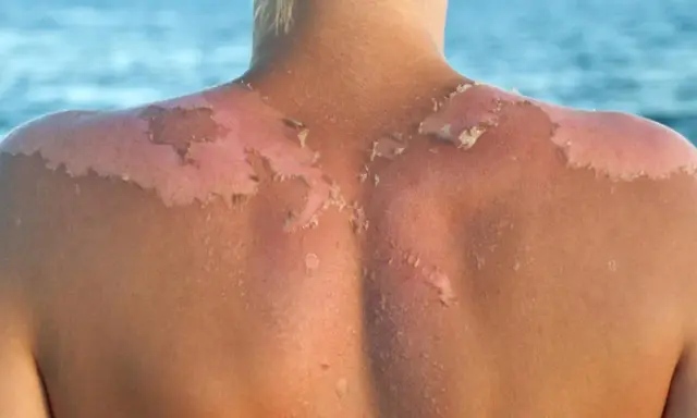 Piel descascarada por quemadura solar. Descubre cómo detener el peeling tras la insolación y aliviar tu piel.