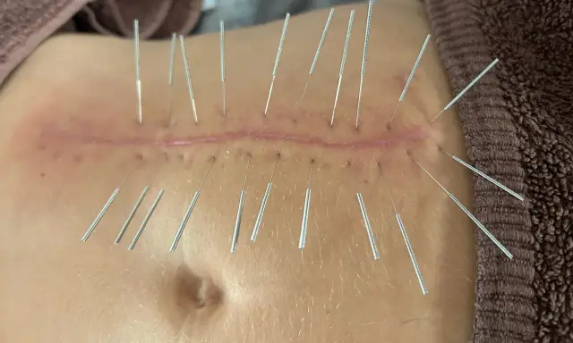 Suche igłowanie blizny po operacji brzucha, mające na celu poprawę jej wyglądu i elastyczności.