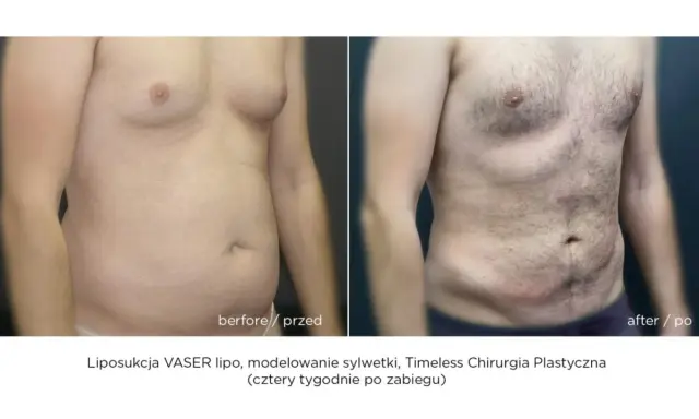 Liposukcja: Modelowanie sylwetki, nie odchudzanie. Poznaj fakty!