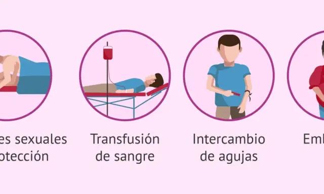 Ilustraciones muestran cómo se puede dar el contagio de clamidia: relaciones sexuales sin protección, transfusión de sangre, intercambio de agujas y embarazo.