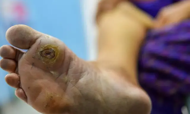 Pied diabétique grade 3 avec une plaie ouverte sur la plante du pied, nécessitant des soins médicaux urgents.