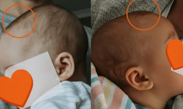 Dwa zdjęcia główki dziecka, pokazujące niezrośnięte ciemiączko u dwulatka. Pomarańczowe kółka zaznaczają obszar ciemiączka.