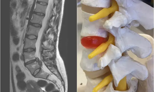 MRI kręgosłupa lędźwiowego obok modelu anatomicznego ukazującego sekwestrację dysku uciskającą nerw.