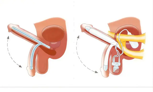Ilustracja przedstawia działanie protezy penisa. Po lewej stronie widać implant w stanie spoczynku, po prawej - po aktywacji.