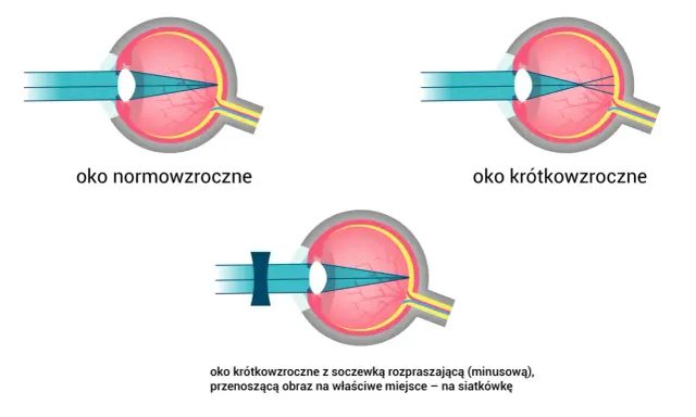 Ilustracja oka: normowzroczne, krótkowzroczne i krótkowzroczne z soczewką korygującą.