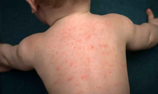 Schiena di neonato con eruzione cutanea rossa diffusa, forse dovuta a sudorina sulla pelle.