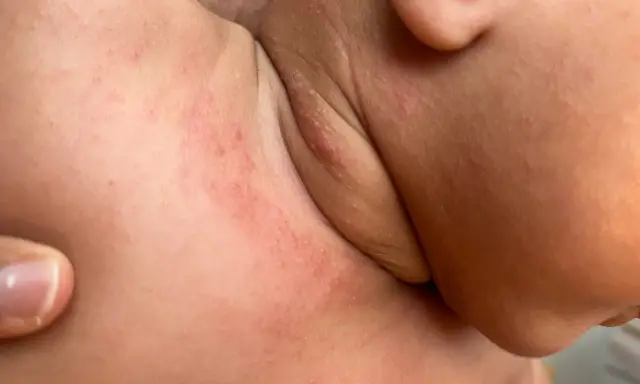Irriterade halsveck hos en bebis, med små röda prickar och knottror som visar sig i hudveck.