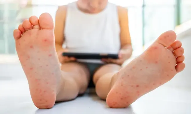 Pies de niño con erupción roja, posible síntoma de rubeola.