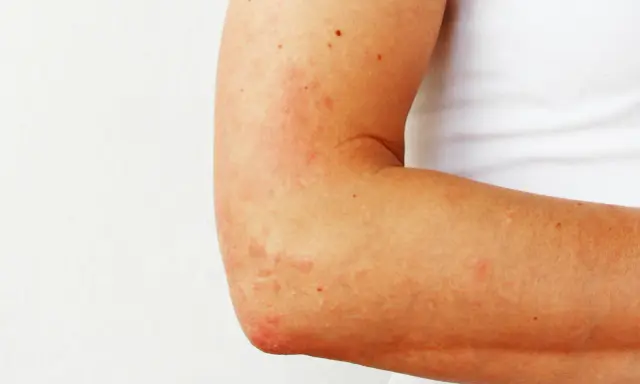 Plaques rouges et irritées sur le coude, signe d'eczéma.