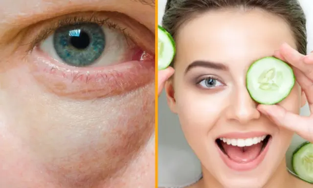 Ojo con bolsas y ojeras, y una mujer sonriente con rodajas de pepino, mostrando remedios caseros para las bolsas en los ojos.