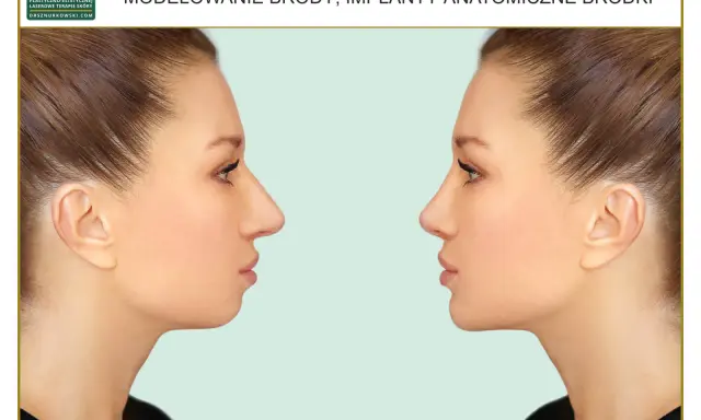 Przed i po zabiegu modelowania brody. Genioplastyka poprawiająca profil twarzy.
