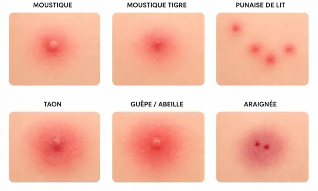 Comparaison de six types de piqûres : moustique, moustique tigre, punaise de lit, taon, guêpe/abeille et araignée. Chaque image montre un différent bouton sur la peau.