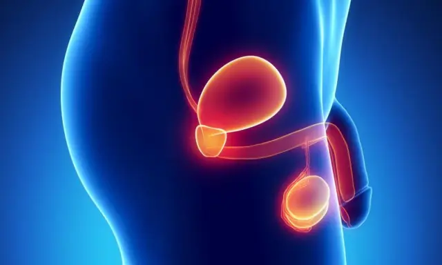 Ilustracja anatomiczna męskiego układu rozrodczego. Widoczna jest prostata, pęcherz moczowy i jądra. Obraz może symbolizować raka prostaty przerzuty.