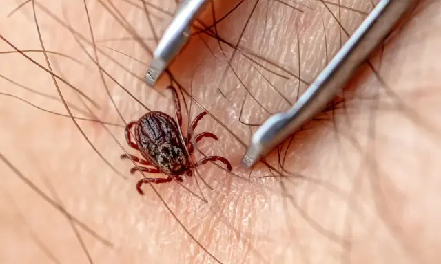 Usuwanie kleszcza: 4 kroki, narzędzia, mity. Chroń zdrowie!