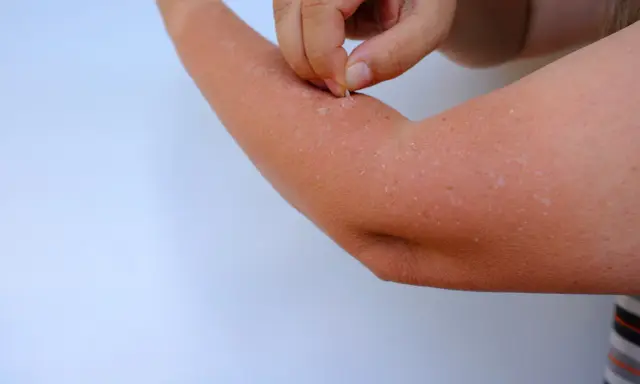 Main d'une personne qui retire des lambeaux de peau qui pèle sur son bras, signe d'un coup de soleil.