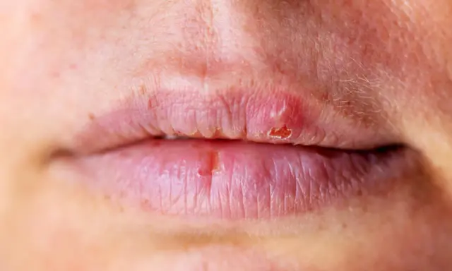 Labbra secche e screpolate, con piccole lesioni. Potrebbe essere un segnale che il fegato ha bisogno di attenzione.