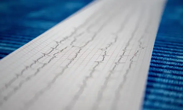 Wynik badania EKG, zapis fal na papierze milimetrowym.
