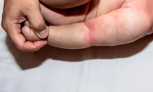 Dłoń rodzica delikatnie obejmuje ramię niemowlaka, na którym widoczna jest szorstka skóra, zaczerwieniona i lekko podrażniona.
