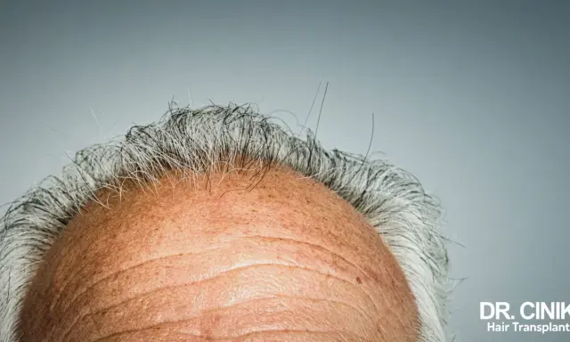 Gros plan sur le front d'un homme aux cheveux gris clairsemés. La vitamine D, source de bienfaits pour les cheveux, est essentielle pour leur santé.