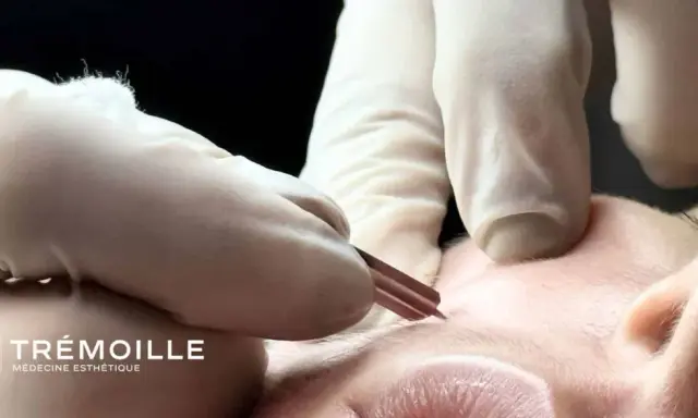 Gants blancs et outil fin pour l'extraction de gros points noirs sur le nez. Soin esthétique précis.