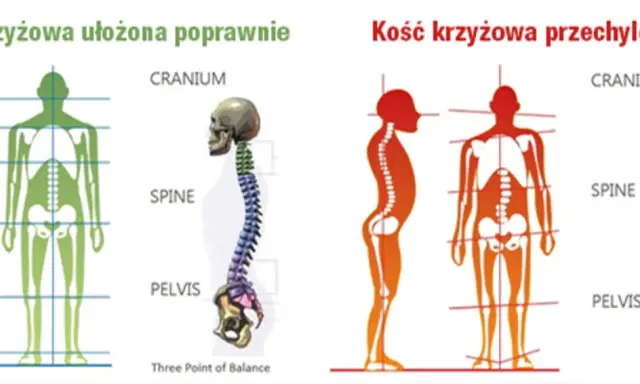 Prawidłowe i przechylone ułożenie kości krzyżowej kręgosłupa. Porównanie postawy ciała.