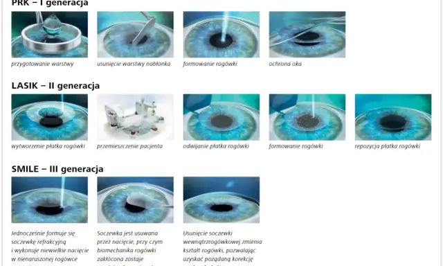 Ilustracje pokazują metody korekcji wzroku: PRK, LASIK, SMILE. Pytanie, czy wada wzroku minus może się cofnąć, jest kluczowe dla wyboru metody.