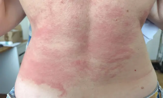 Le dos présente des rougeurs et des plaques, signe d'une réaction cutanée. Il est urgent de trouver une solution pour calmer les démangeaisons.