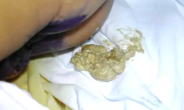 Feci grasse e giallastre, indicative di steatorrea, su un pannolino. Le cause possono essere molteplici.