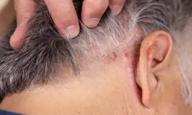 Main d'une personne grattant son cuir chevelu, révélant des plaques sèches et irritées, signe d'une démangeaison cuir chevelu persistante.