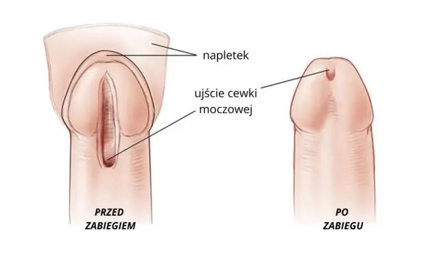 Przed i po zabiegu: ujście cewki moczowej u mężczyzn, z napletkiem.