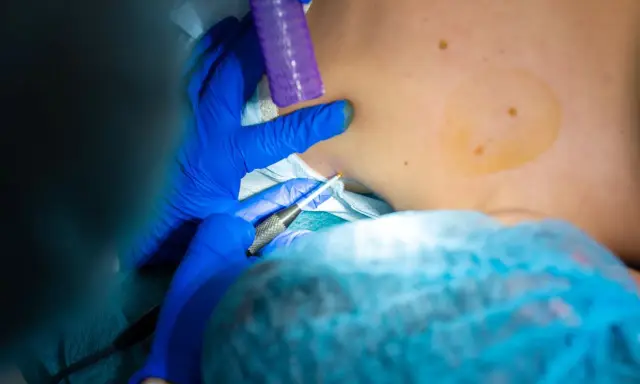 Lekarz pobiera próbkę tkanki. Czy biopsja oznacza raka? Nie zawsze, to ważny krok diagnostyczny.