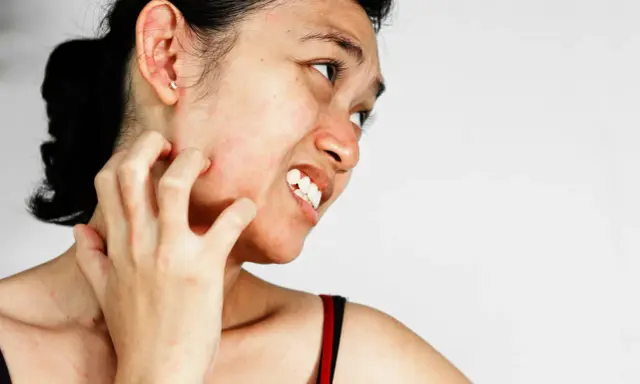Une femme se gratte le cou et le visage, visiblement gênée par une peau très sèche et des démangeaisons.