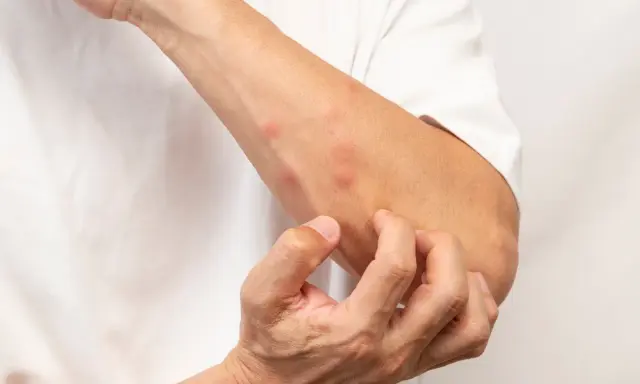 Un bras couvert de boutons rouges, la personne se gratte pour savoir comment ne pas se gratter les boutons de moustiques.
