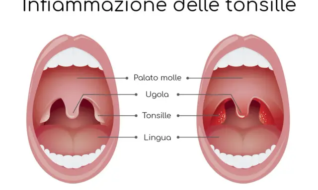 Illustrazione che mostra un'infiammazione delle tonsille, comune nel mal di gola dei bambini. Le tonsille gonfie e rosse sono visibili.