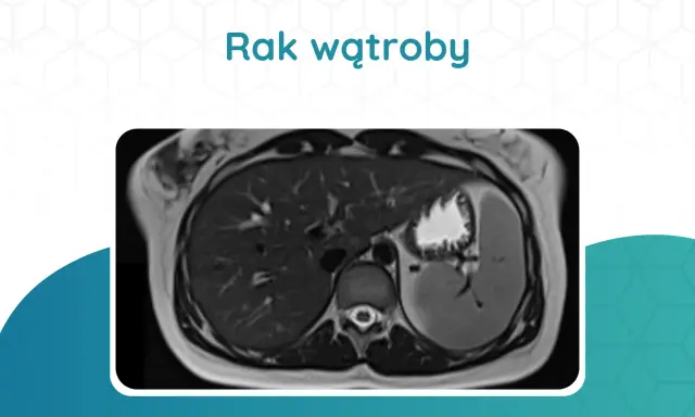 Przekrój tomografii komputerowej wątroby z widocznym guzem.