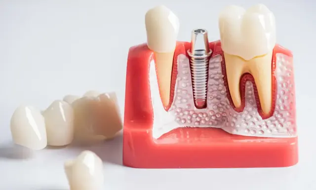 Ból po wyrwaniu ósemki: Ile trwa, co jest normą i kiedy do dentysty?