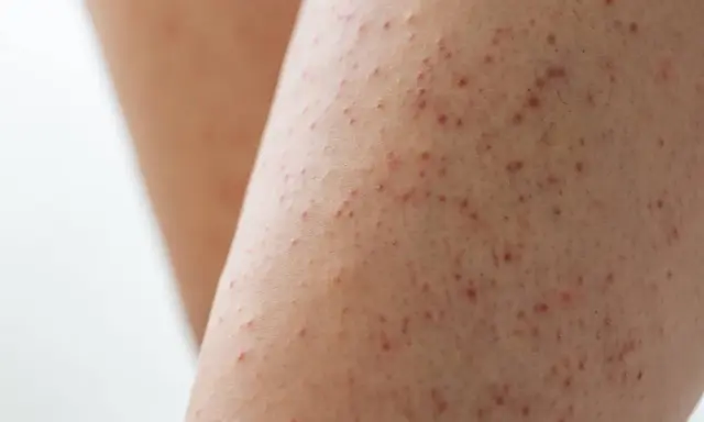 Gros plan sur une peau présentant des petites bosses rouges, typiques de la kératose pilaire.