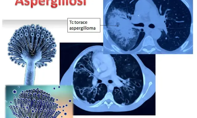 Aspergillosi: immagini di Aspergillus e TAC polmonari che mostrano un aspergilloma. L'aspergillosi è contagiosa.