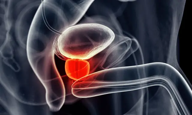 Anatomical illustration showing the bladder and prostate. The third lobe of the prostate is highlighted in red, indicating potential inflammation or abnormality.