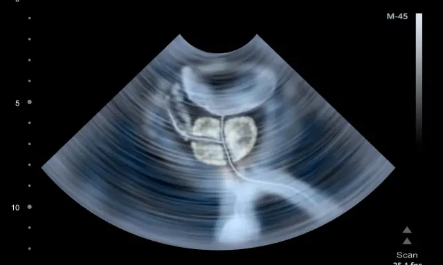 USG prostaty. Częste oddawanie moczu po operacji prostaty może być związane z różnymi czynnikami, które lekarz oceni.