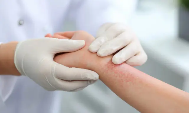 Mains gantées examinant une éruption cutanée rouge sur un poignet, suggérant un traitement eczema.