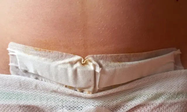 Närbild på ett ärr efter kejsarsnitt med ett vitt förband. Det kan vara tecken på komplikationer efter kejsarsnitt.