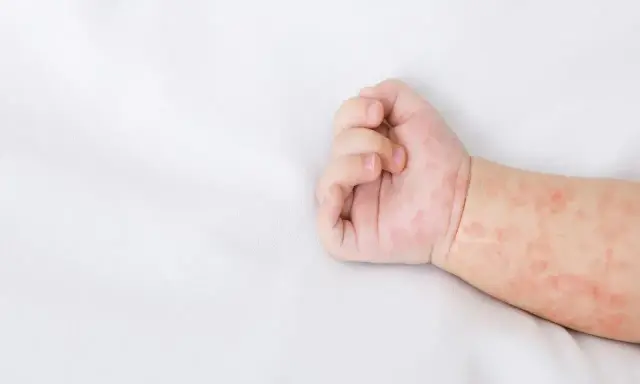 Różowa wysypka u niemowlaka na rączce. Skóra dziecka jest zaczerwieniona i pokryta drobnymi plamkami.