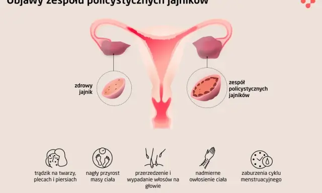 PCOS: Co to jest? Objawy, leczenie i życie z Zespołem Policystycznych Jajników
