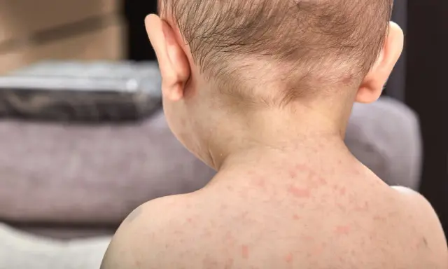 Skóra dziecka pokryta drobnymi, czerwonymi krostkami. To typowa wysypka po trzydniówce, która pojawia się po ustąpieniu gorączki.