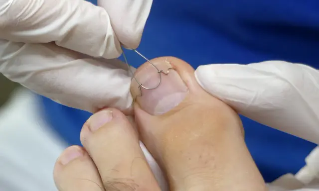 Pose d'une orthonyxie sur un ongle de pied. Une solution pour le remboursement sécurité sociale des soins podologiques.