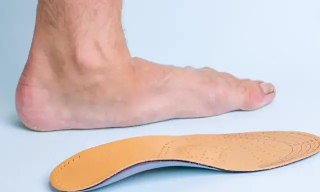 Un pied humain et une semelle orthopédique, conçue pour soulager les douleurs liées aux durillons et aux problèmes de voûte plantaire.