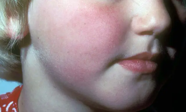 Barnets kinder är röda, vilket kan vara ett tecken på hjärnhinneinflammation. Utslagen är diffusa och rodnande.