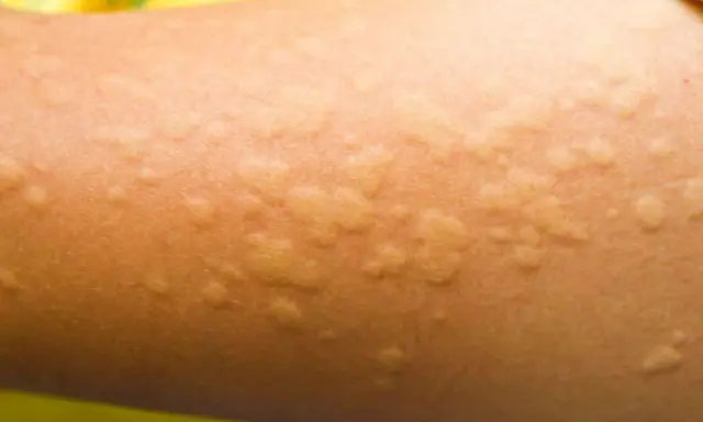 Pelle di bambino con pomfi rossastri e gonfi, tipici dell'orticaria.