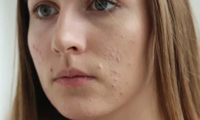 Sudocrem na pryszcze: Kiedy pomaga, a kiedy szkodzi?